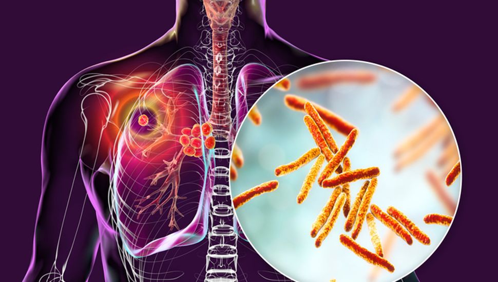 Se notificaron más de 13 mil casos de tuberculosis en Argentina