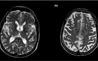 Descubren una proteína que preserva al cerebro del daño del envejecimiento