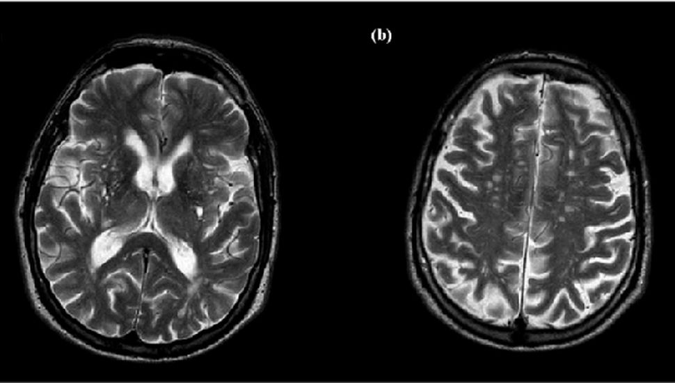 Descubren una proteína que preserva al cerebro del daño del envejecimiento