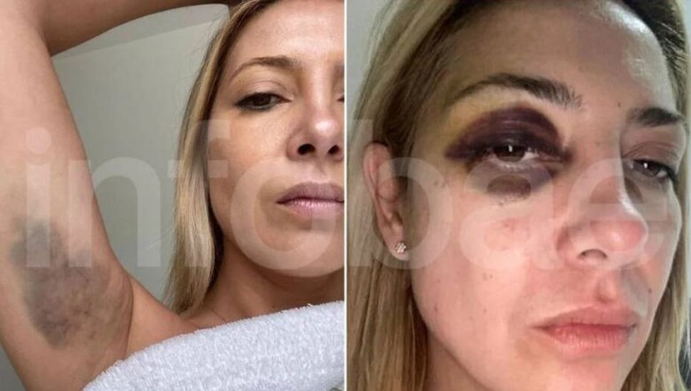 Aparecieron las fotos de Fabiola Yáñez golpeada