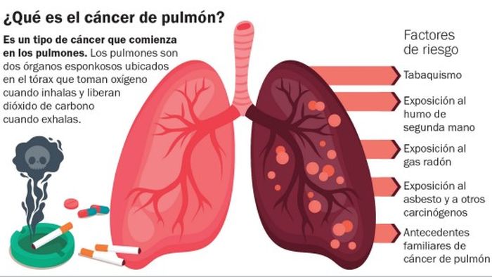 Cáncer de pulmón: contar con mejores posibilidades