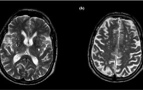 Descubren una proteína que preserva al cerebro del daño del envejecimiento